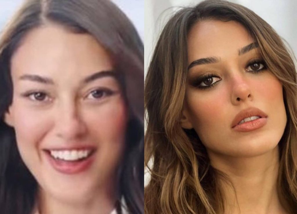 Dilan Çiçek Deniz yüzündeki değişimle gündemde! Estetik yaramadı...