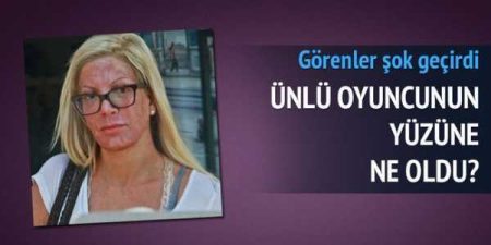 Ünlü oyuncu cilt bakımı sonrası talihsizliği