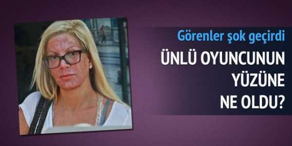 Ünlü oyuncu cilt bakımı sonrası talihsizliği